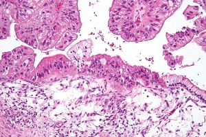 1024px-Mucinous_lmp_ovarian_tumour_intermed_mag