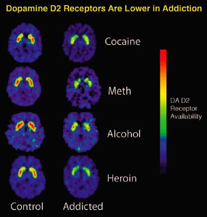Dopamine_D2_Receptors_in_Addiction.jpg